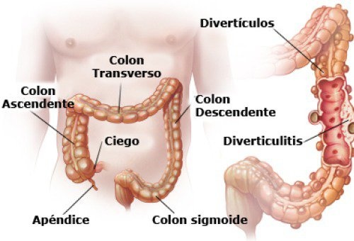 Diverticulite e Diverticulose causas, sintomas e tratamento Tudo Ela