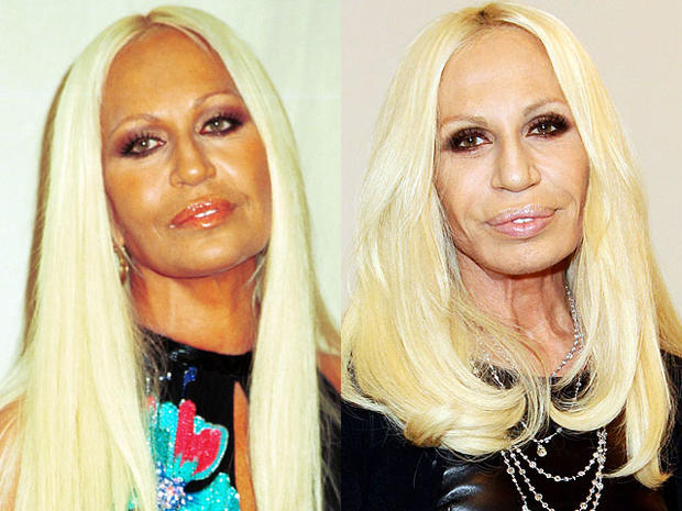 donatella-beforeafter