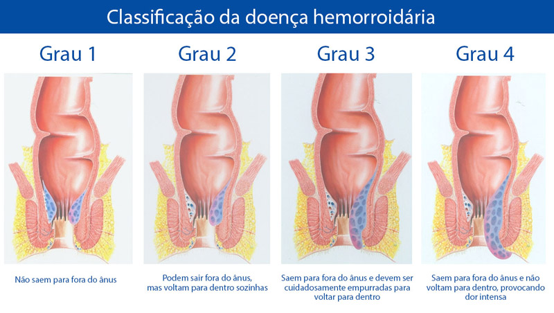 Стадии геморроя схема у женщин